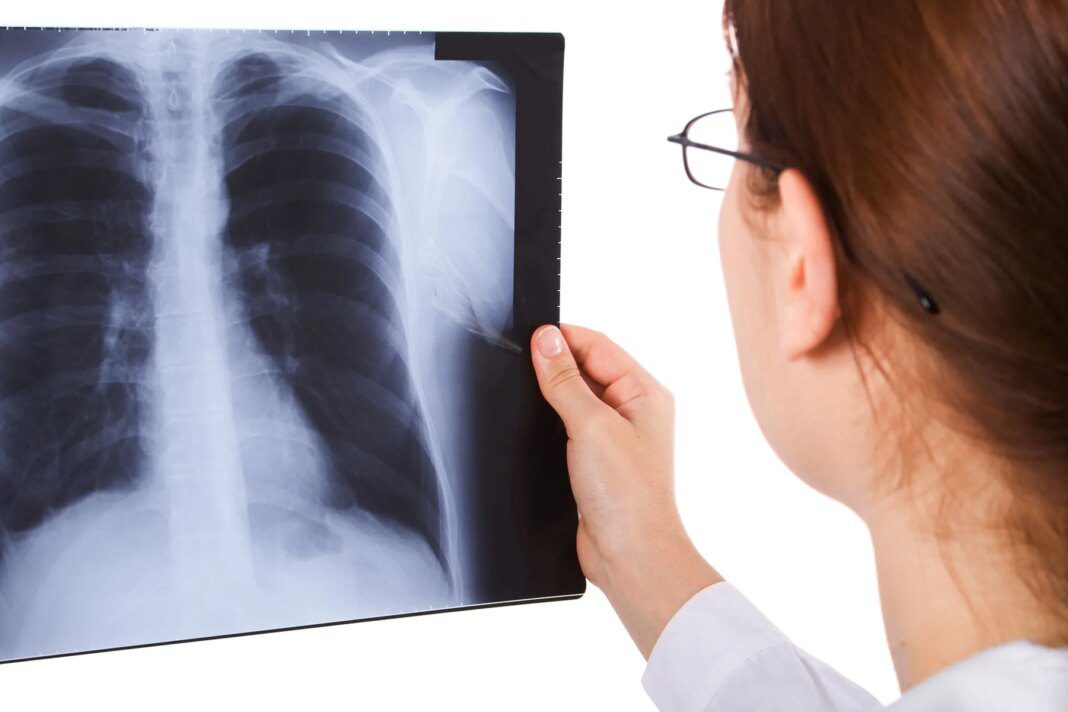 The Impact of Lung Cancer on Non-Smoking Women