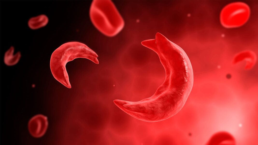 New Study Finds No Signs of Opioid Misuse in Children with Sickle Cell Disease