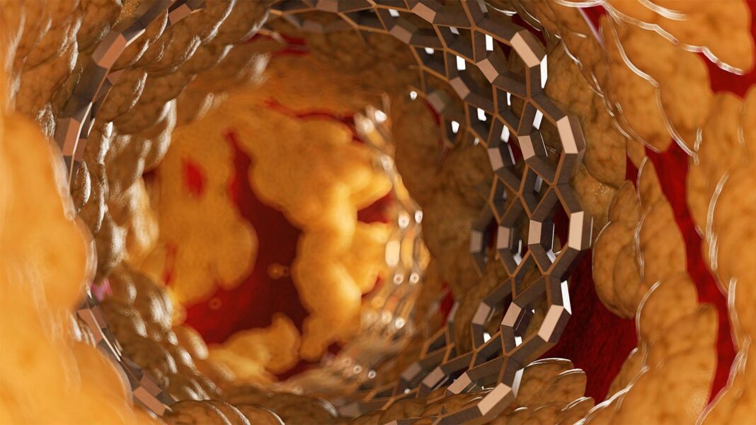 Breakthrough: Intravascular Imaging Guides PCI to Improved Survival and Reduced MIs