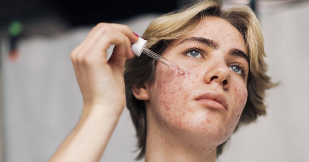 Effective Ways to Finally Banish Stubborn Under the Skin Pimples